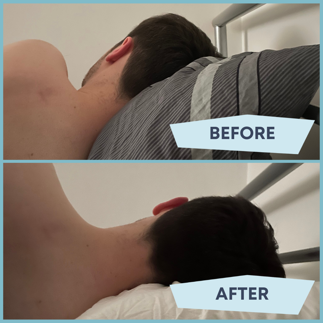 before and after of sleeping on levitex sleep posture pillow